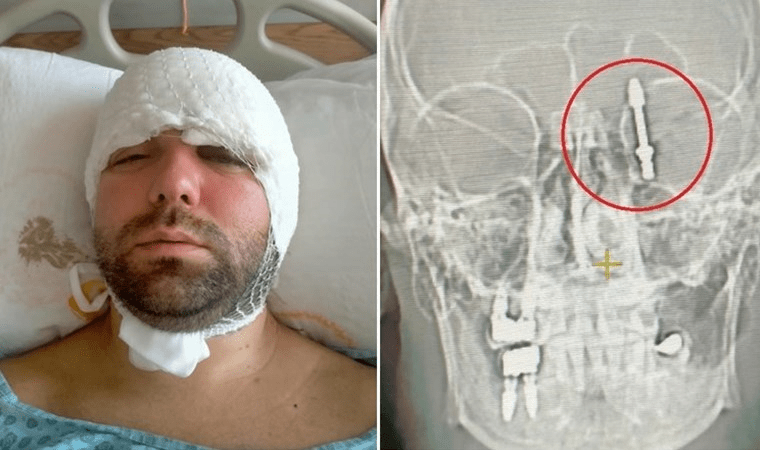 Bursa’da Diş İmplantı Ameliyatı Korkunç Bir Kazayla Sonuçlandı
