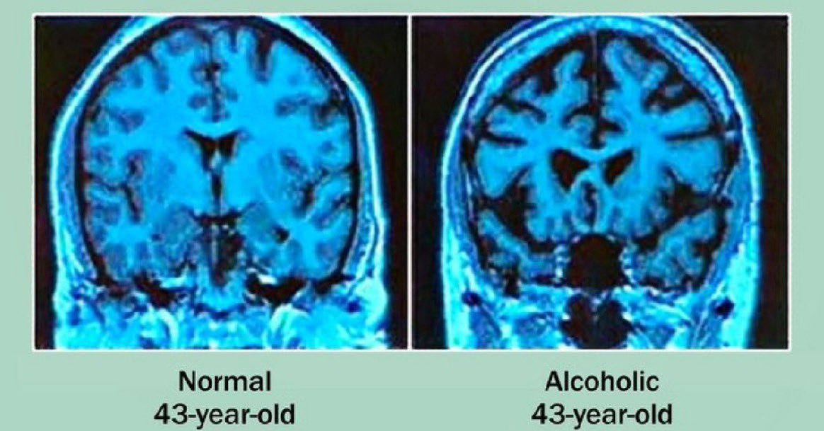 Alkolün Uzun Süreli Zararları: Beyin ve Beden Üzerindeki Etkileri