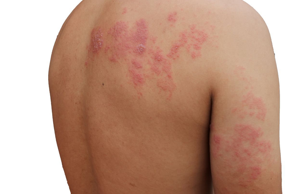 ZONA (Herpes Zoster) ve Gece Yanığı: Nedir, Nedenleri ve Tedavi Yöntemleri