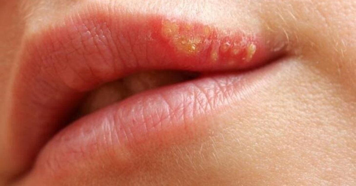 Soğuk Sütle Uçuk Tedavisi: Doğal ve Etkili Yöntem