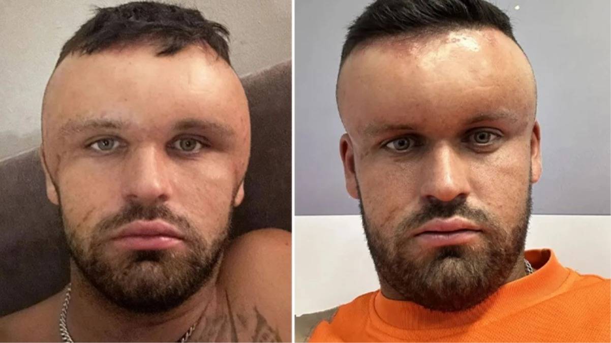 İngiltere'de Saç Boyasından Enfeksiyon Kapan Adamın Kafası Şişti