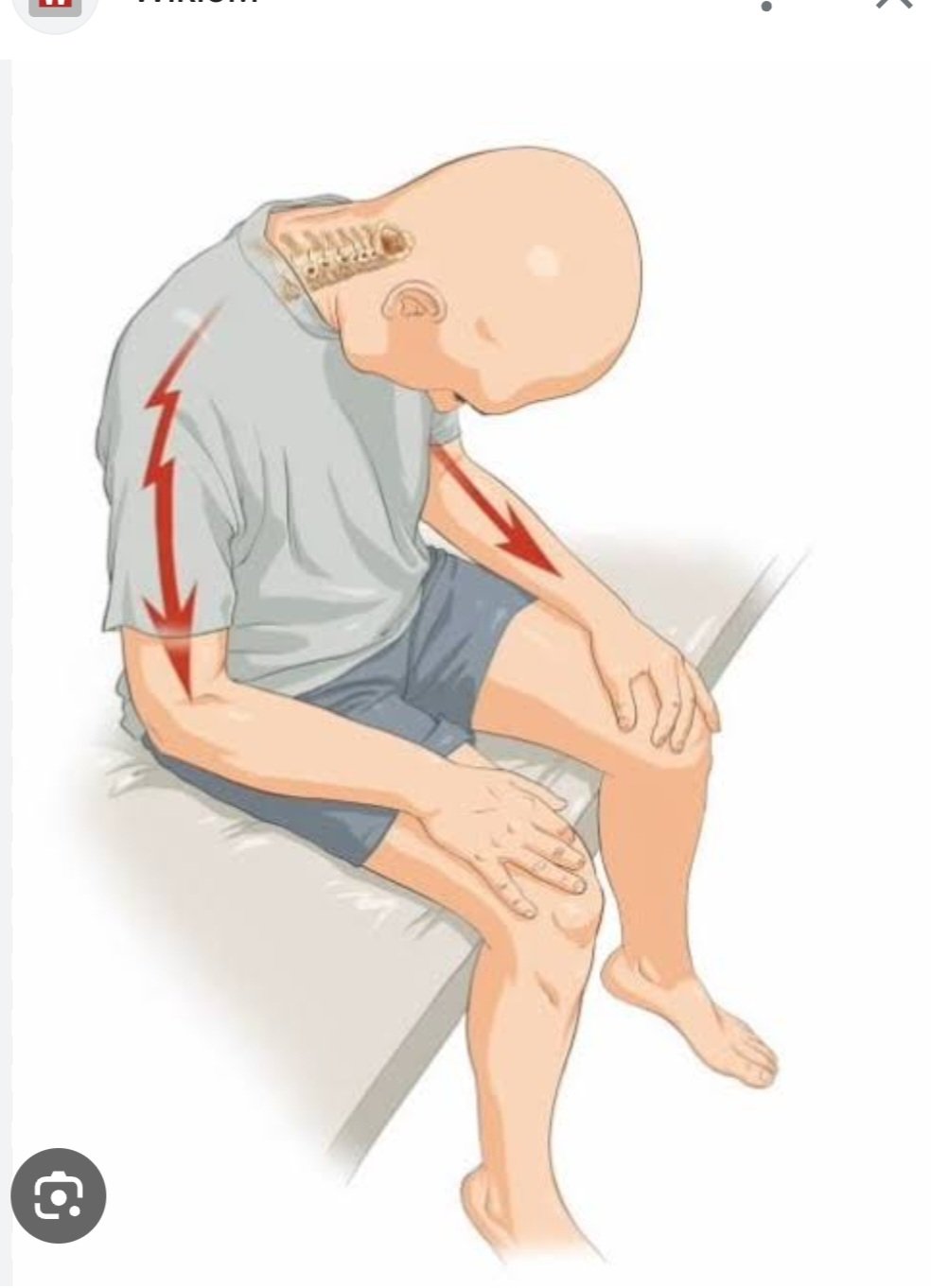 Boyun Omurgasında Tehlikeli Sorun: Lhermitte Bulgusu Nedir?