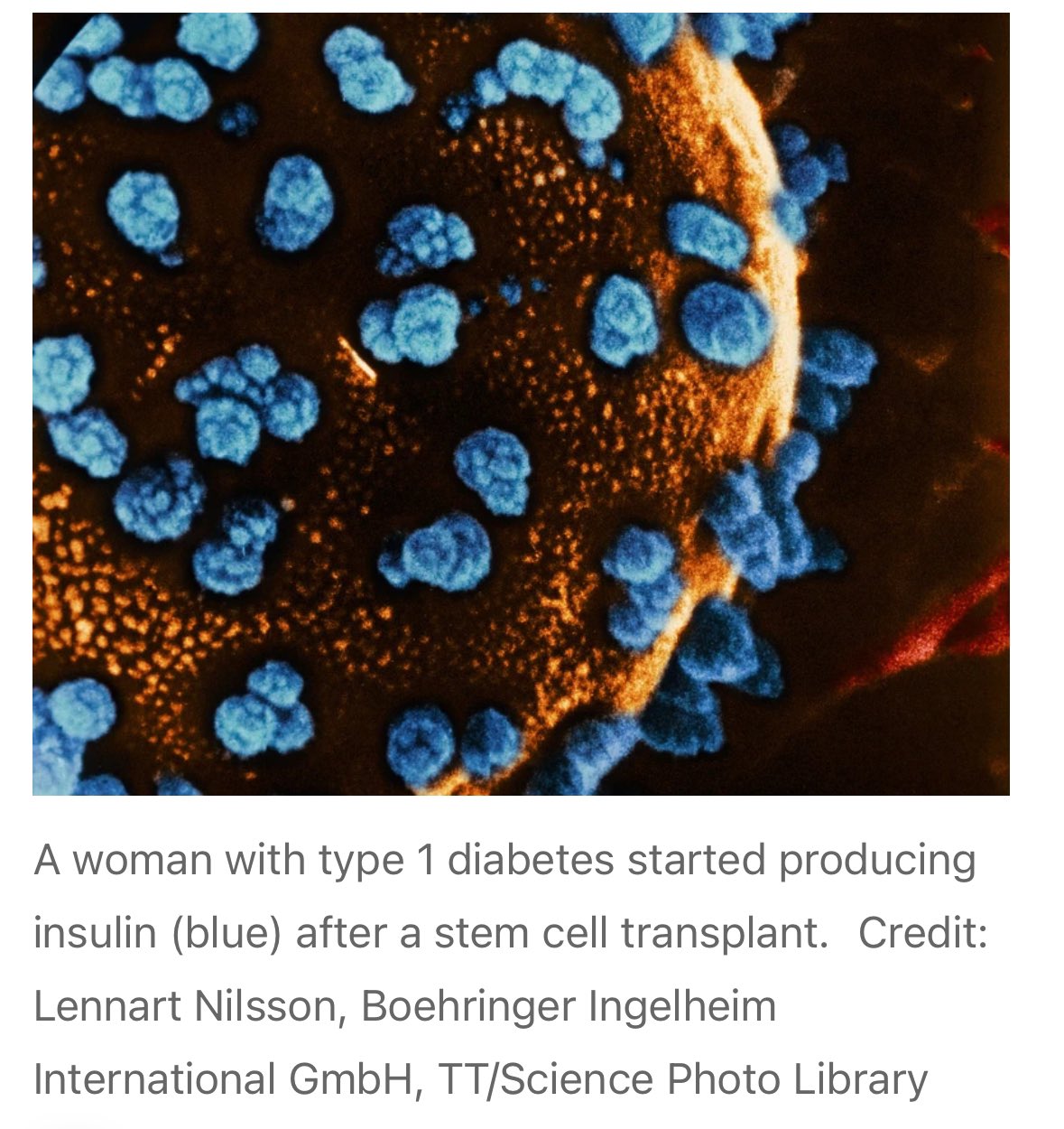 Dünyada Bir İlk: Tip 1 Diyabetli Hasta Kök Hücre Nakli ile Tamamen İyileşti