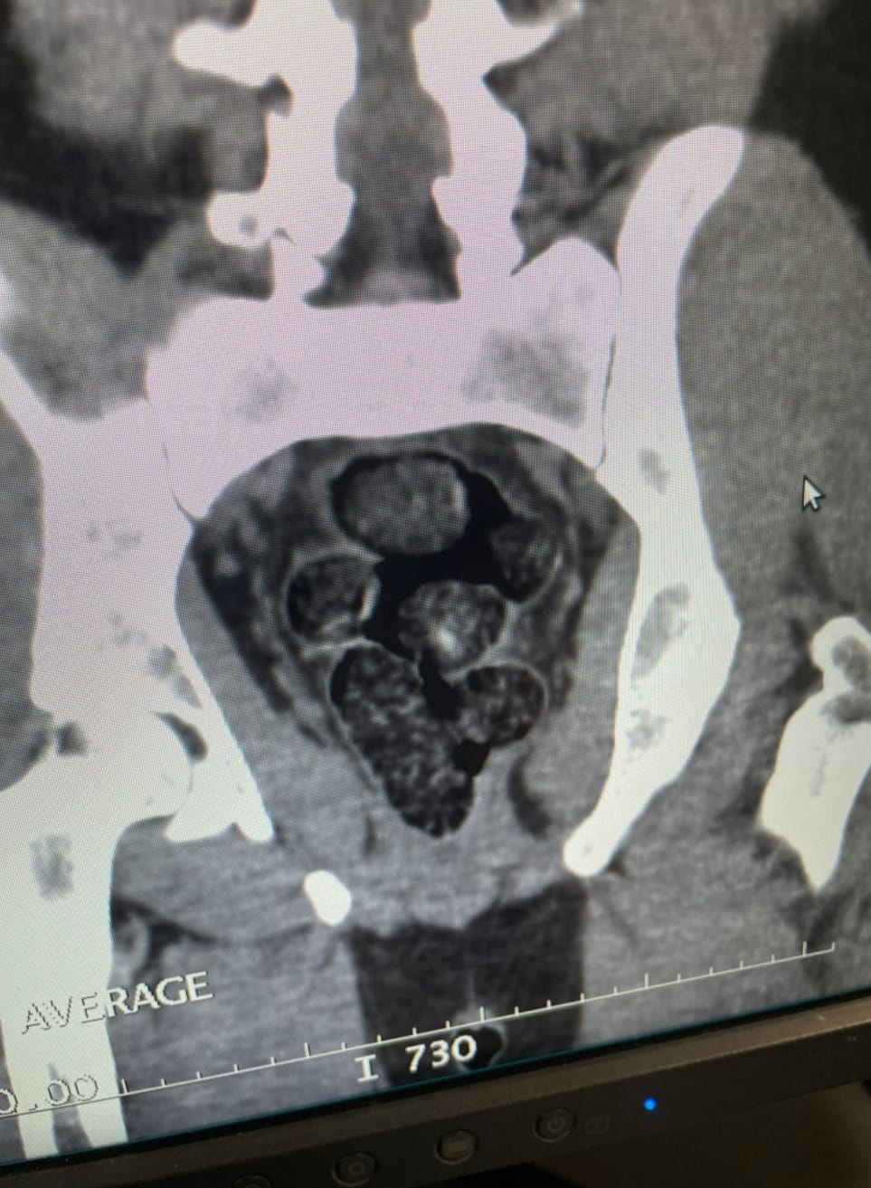 MİDESİNDE UYUŞTURUCUYU SAKLAYARAK ESENBOĞA HAVALİMANI'A GELDİ