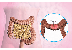 ABD'li doktorlar, kolon kanserinin